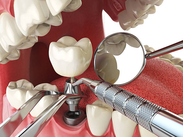 Best Emergency Wisdom Teeth Removal in Ninety Six, SC